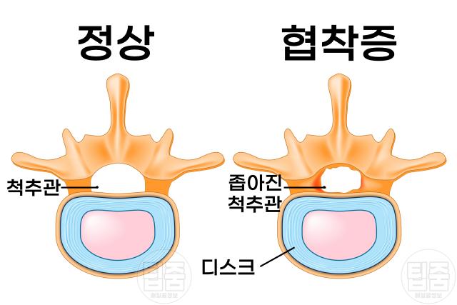허리가 찌릿 아플때 척추관협착증 증상 원인