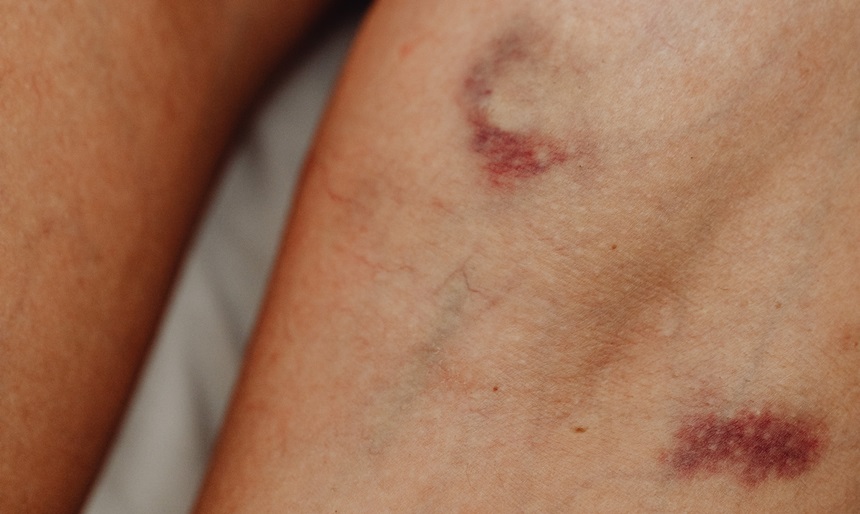 멍 빨리 빼는법