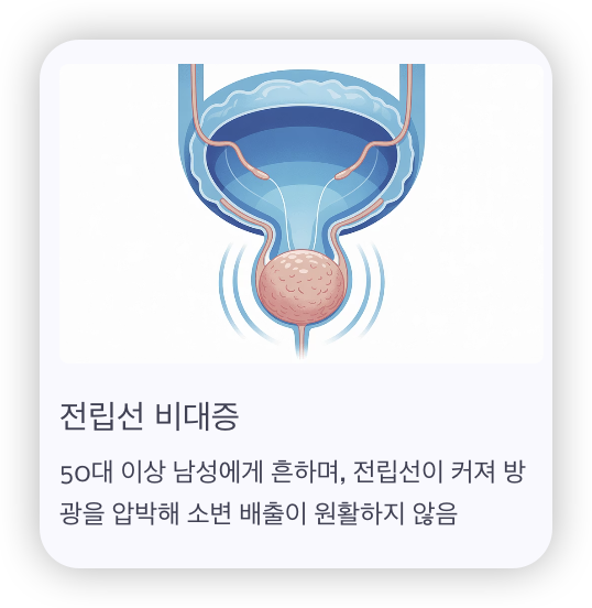 남성-잔뇨감-원인-전립선-비대증