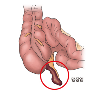 맹장염 관련 사진