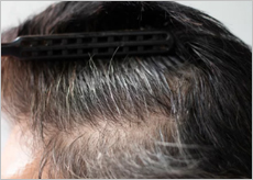 탈모로 고민하는 사람들 이미지