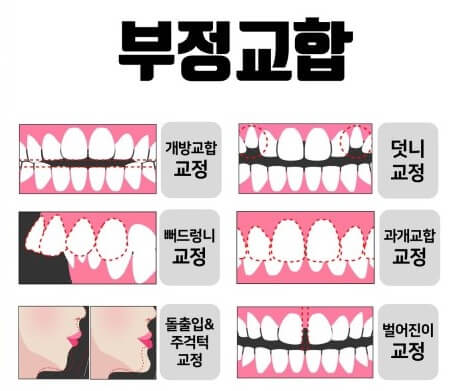 치아 부정교합