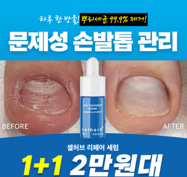 캐시닥 문제성 손발톱 퀴즈 썸네일