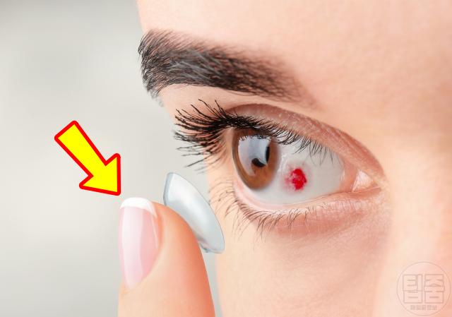 눈 실핏줄 터지는 이유 눈혈관 터짐 결막하출혈 원인 콘택트렌즈 스트레스