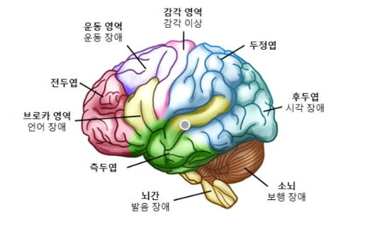 뇌종양으로 인한 인지 저하 증상 인식 관련 이미지