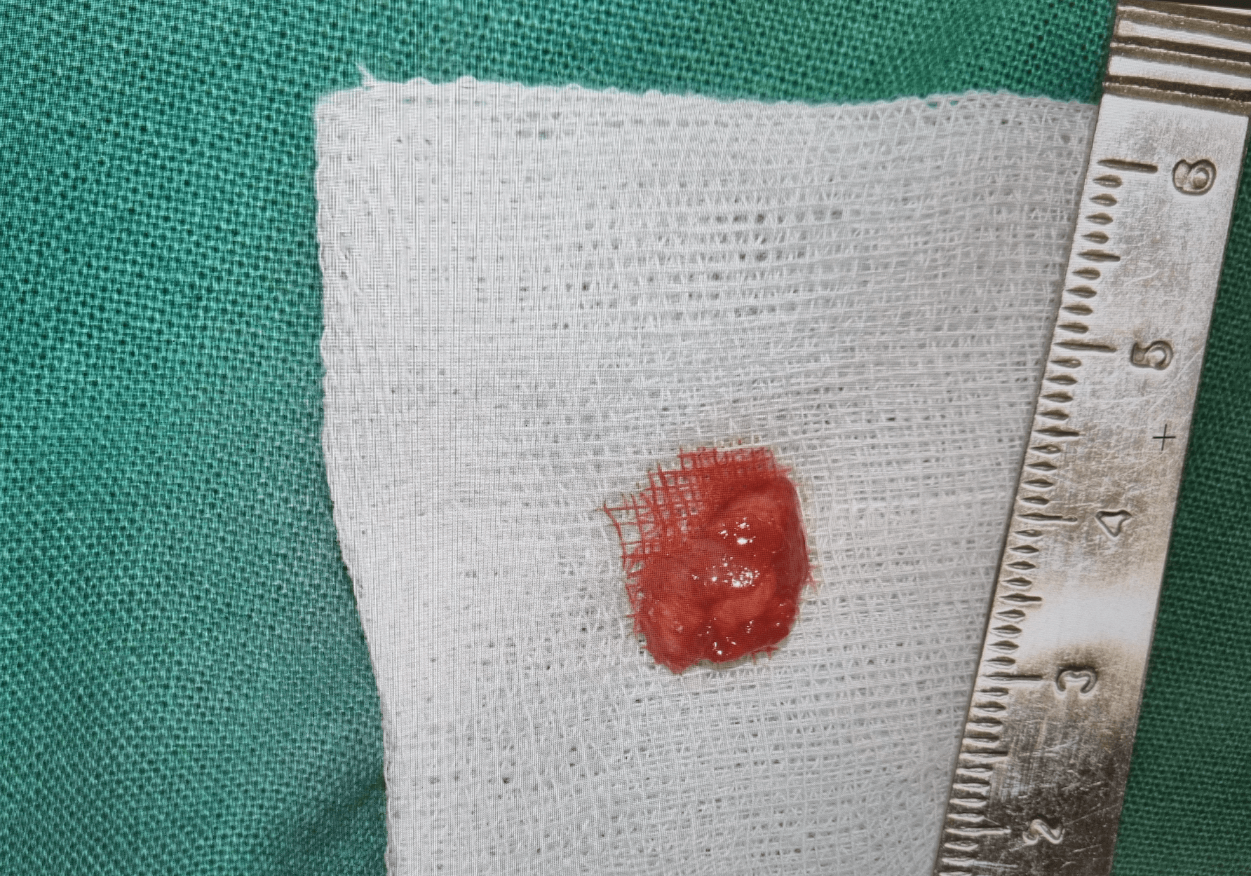 치아 염증 제거