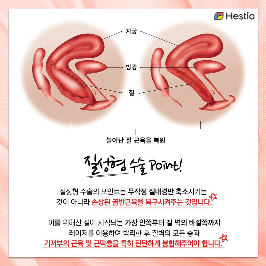 이쁘니수술포인트