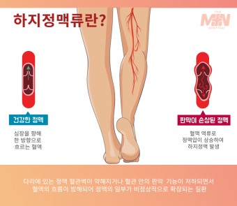 하지정맥류란?
