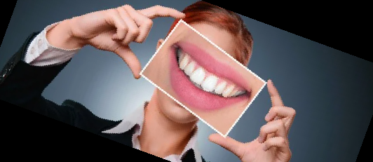 임플란트 가격 종류 비용