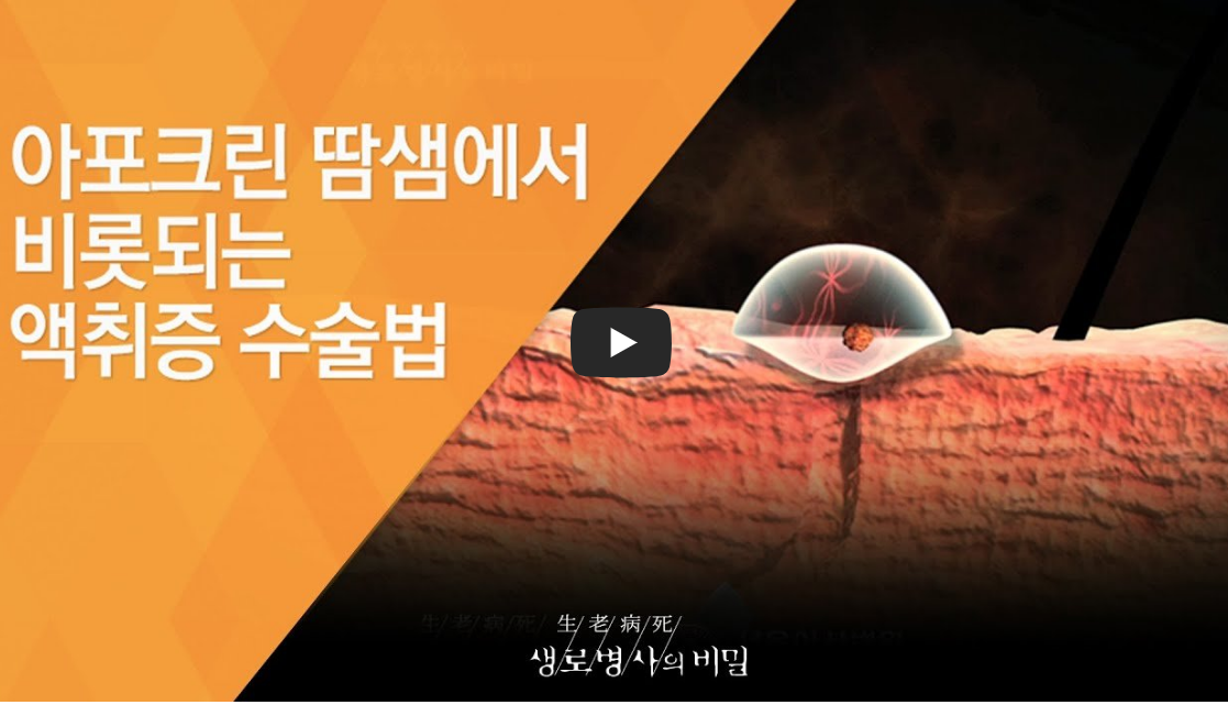 액취증 수술 비수술 및 액취증 원인 증상 치료까지 총정리!