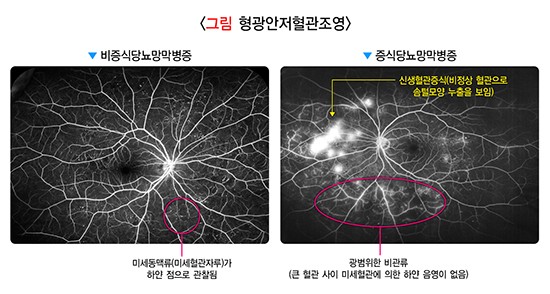 당뇨망막병증