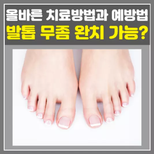 발톱 무좀, 올바른 치료방법과 예방법 총정리