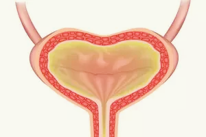 요실금-치료방법