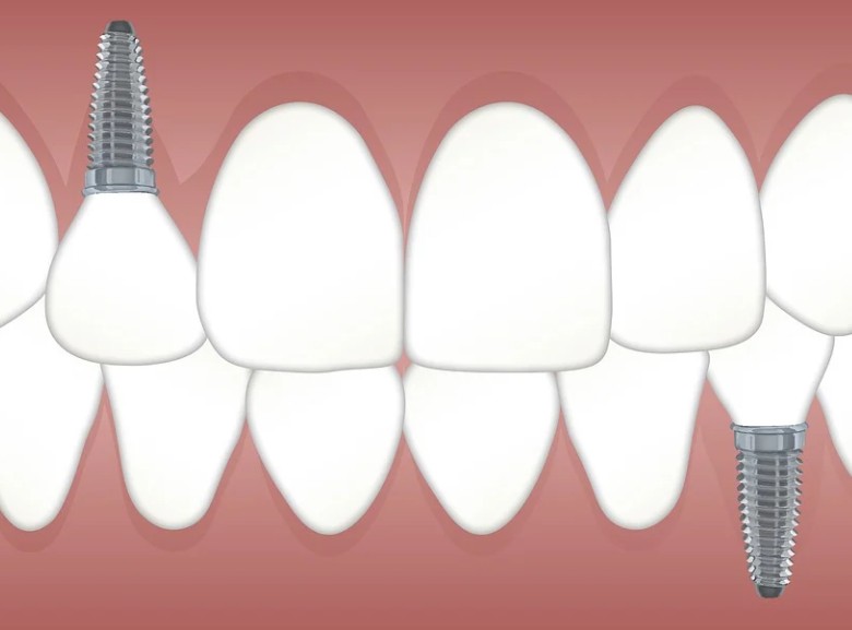 시술후 관리가 중요한 임플란트