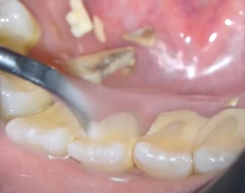 심각하게 축적된 치석제거 모습