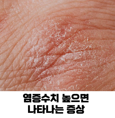 염증수치가 높으면 나타나는 증상