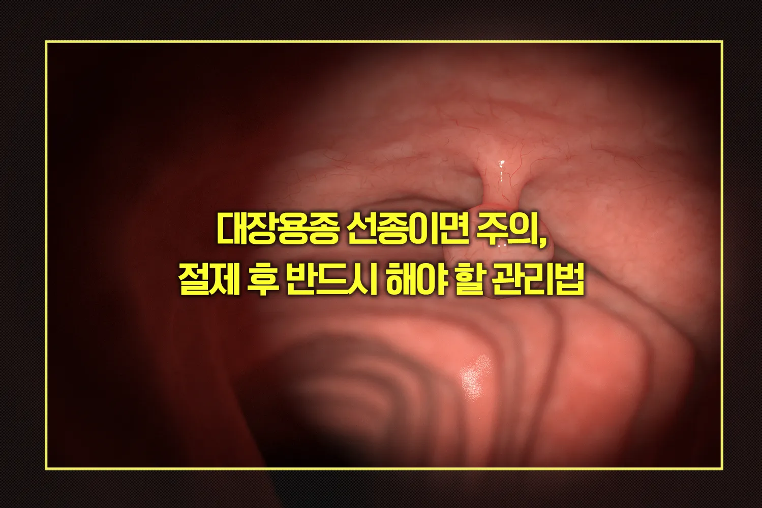 대장용종 선종 절제 후 반드시 해야 할 관리법
