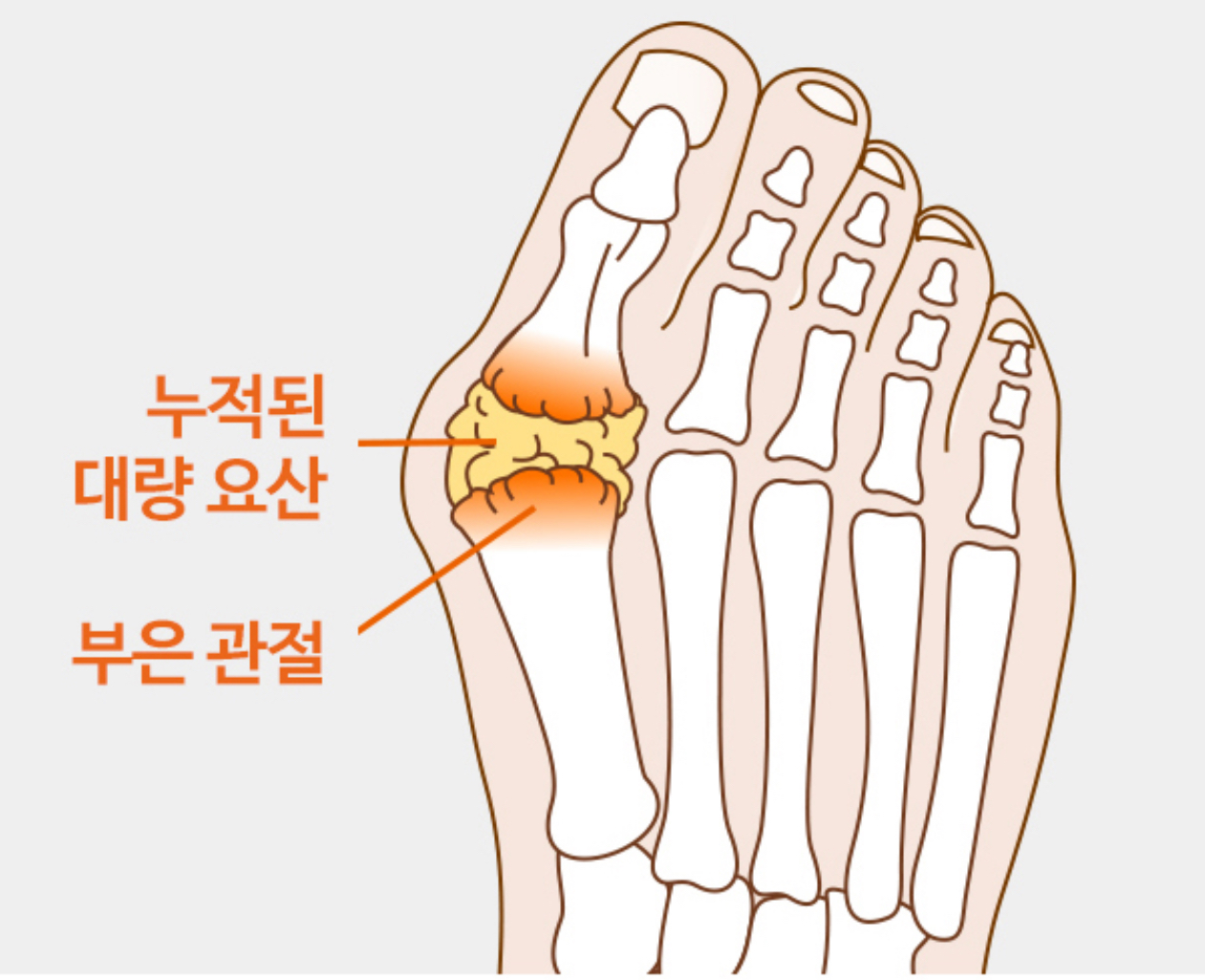 통풍-통풍성관절염