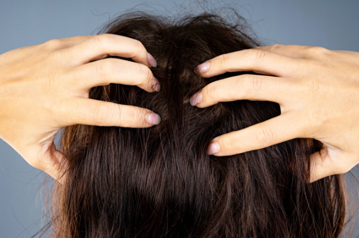 비듬을 예방하기 위한 생활 습관