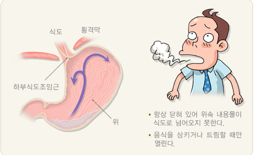 위식도역류질환이나 위궤양에 자큐보정의 효능