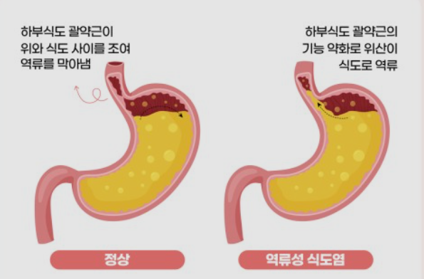 역류성 식도염 증상