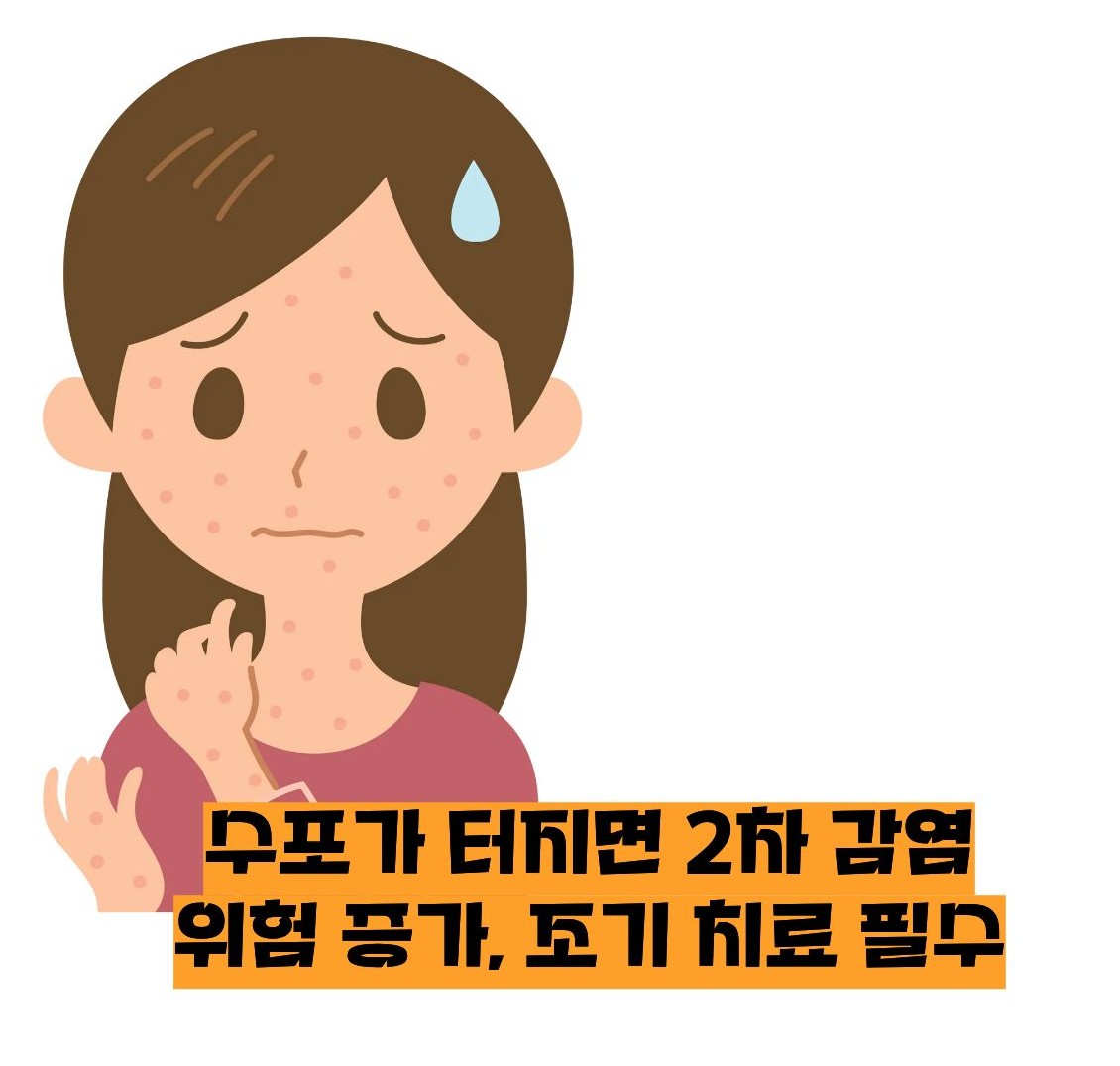 대상포진 초기증상