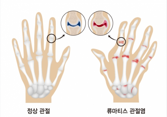 류마티스 관절염