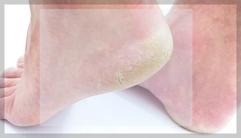 각질형무좀 뒤꿈치