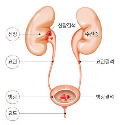 오른쪽 왼쪽 옆구리 뒤쪽 통증