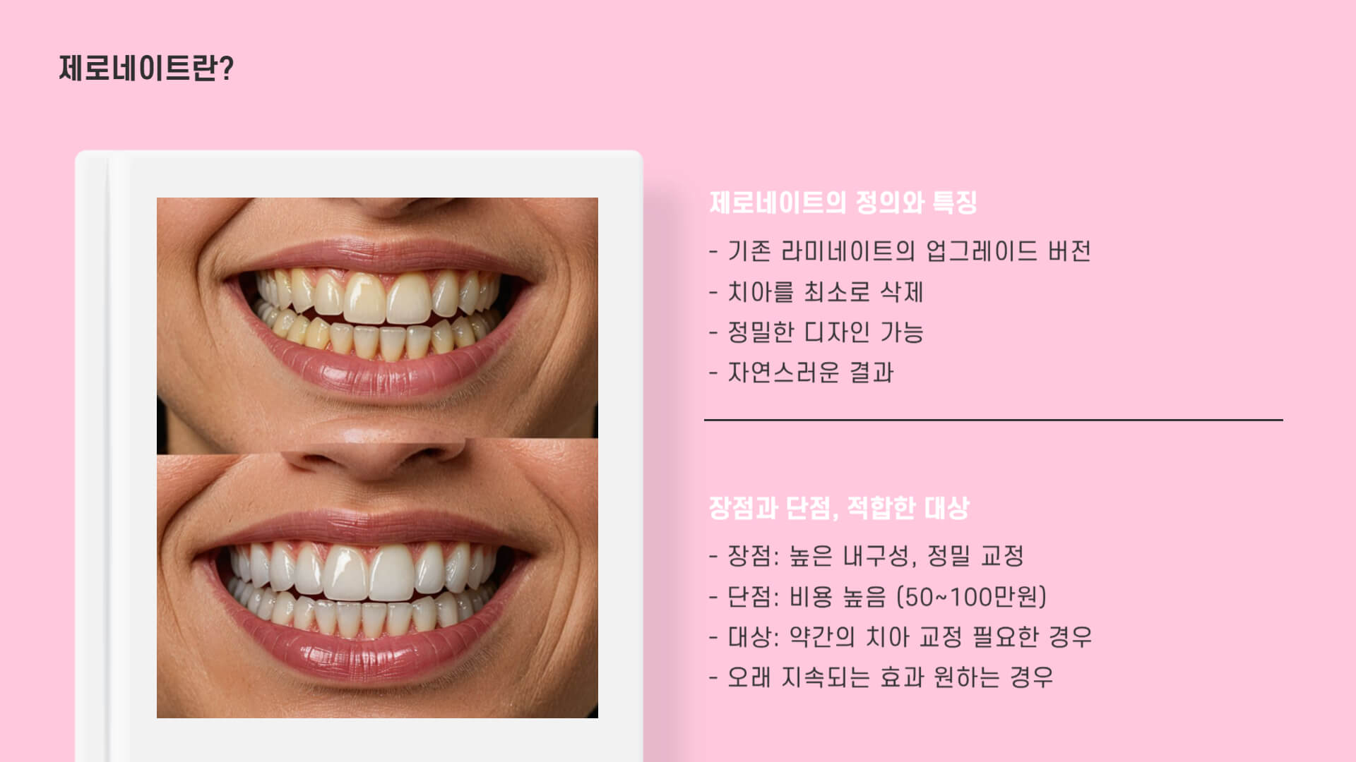 무삭제 라미네이트 vs 제로네이트