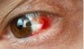 눈 실핏줄이 터지는 이유 및 대처법