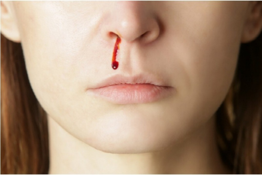 코피가-나는-이유