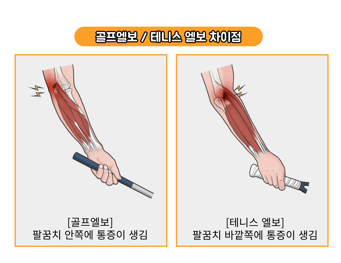 테니스엘보 플렉스바 재활 효과