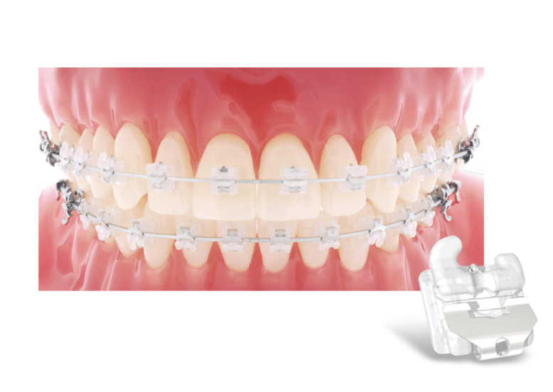 세라믹 브라켓 &amp; 클리어 브라켓: 심미성과 기능의 절충안