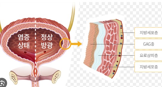방광의 구조사진 방광암 초기치료