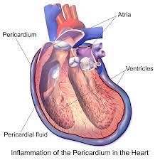 심낭염