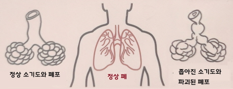 정상폐와 만성폐쇄성폐질환폐 비교