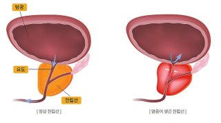 전립선암 증상
