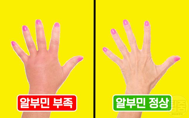 알부민 효능 영양제 효과 있나요 부종