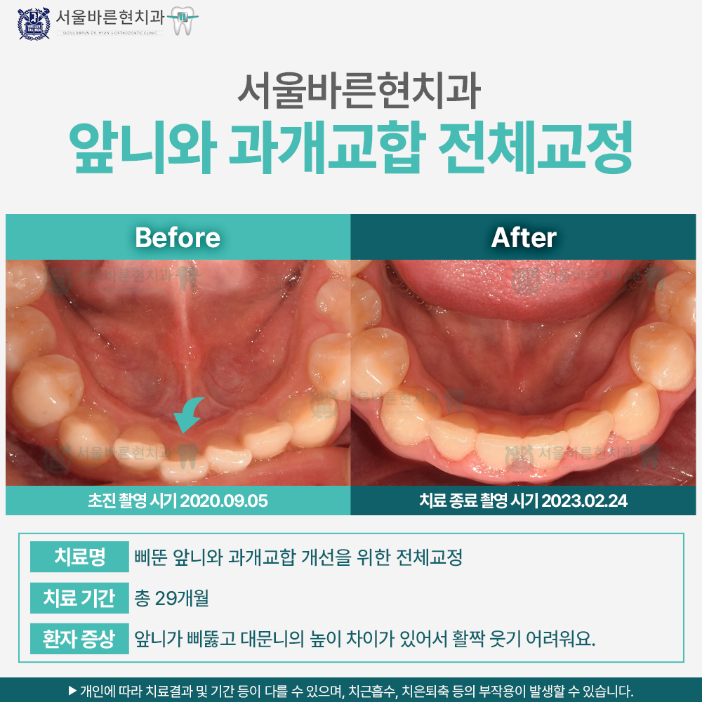 해운대치아교정