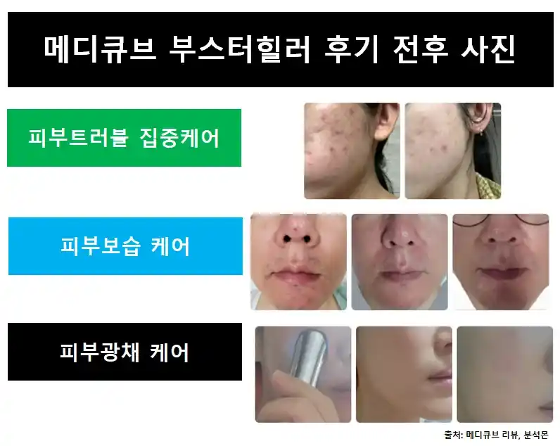 메디큐브부스터힐러사용전후사진
