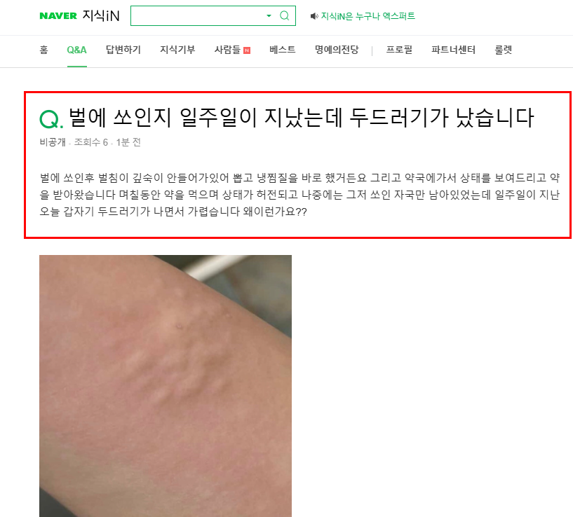 벌에 쏘인지 일주일 후 증상 질문
