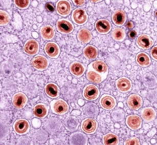 섬유근육통 초기증상 원인 치료법