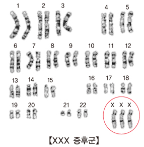 초여성증후군