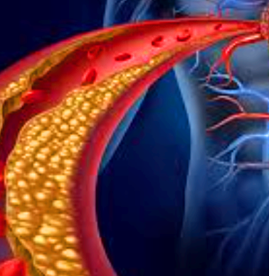동맥경화증 초기증상