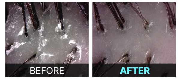  두피와 탈모가 걱정이라면? 