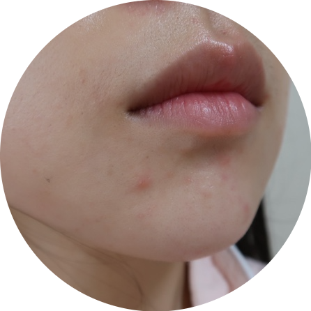 bbl 레이저 후기