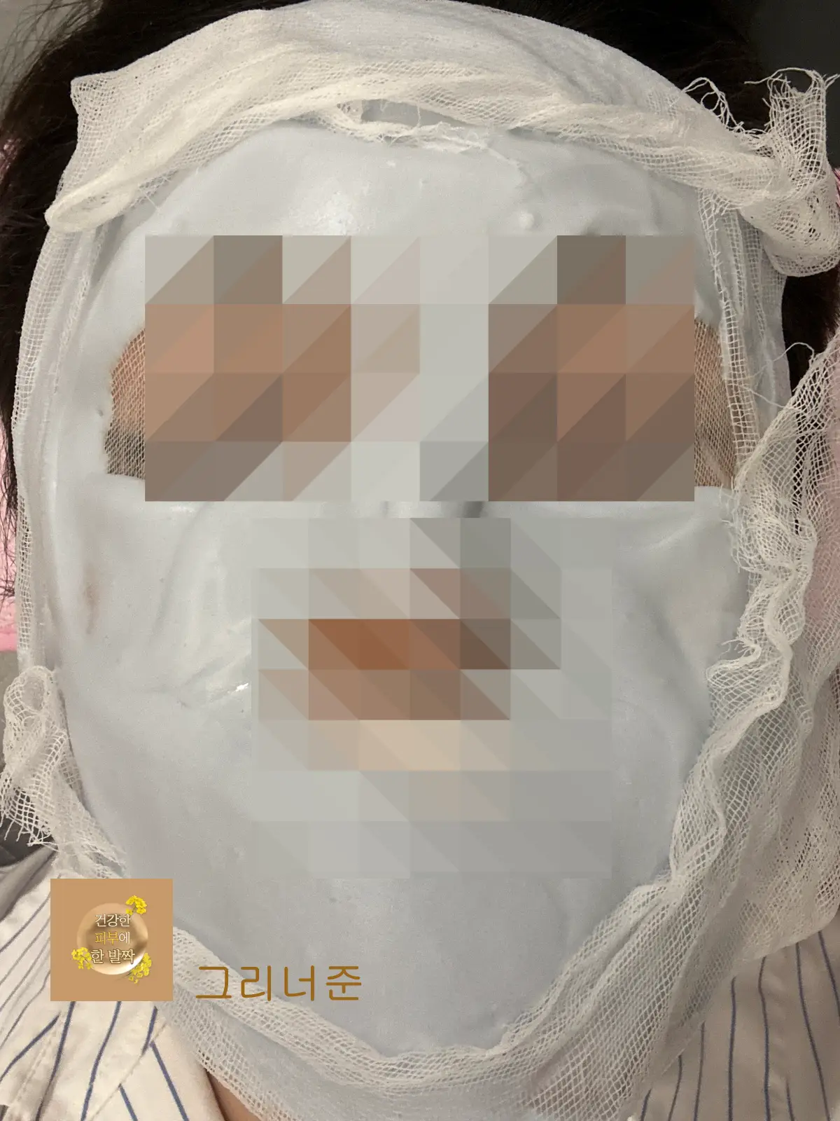 피부과-시술-직후-모델링-팩-얼굴에-얹음