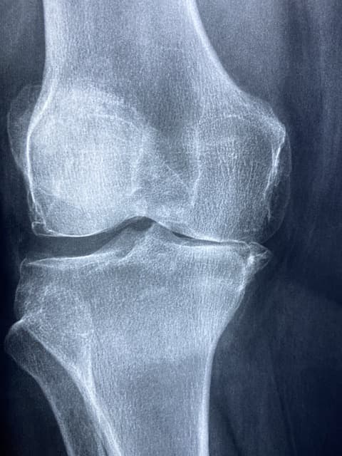 관절염 환자의 X-ray