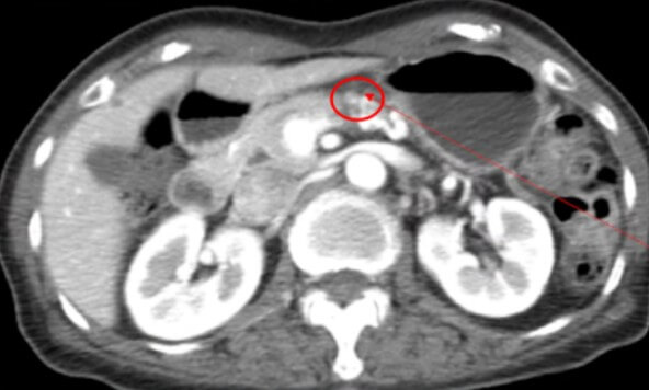 사람의 신체 부위 중 췌장 엑스레이 사진